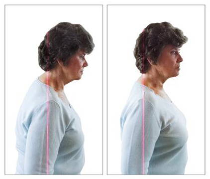 Start Feeling Better By Getting Rid Of Your Buffalo Hump - Pure Posture